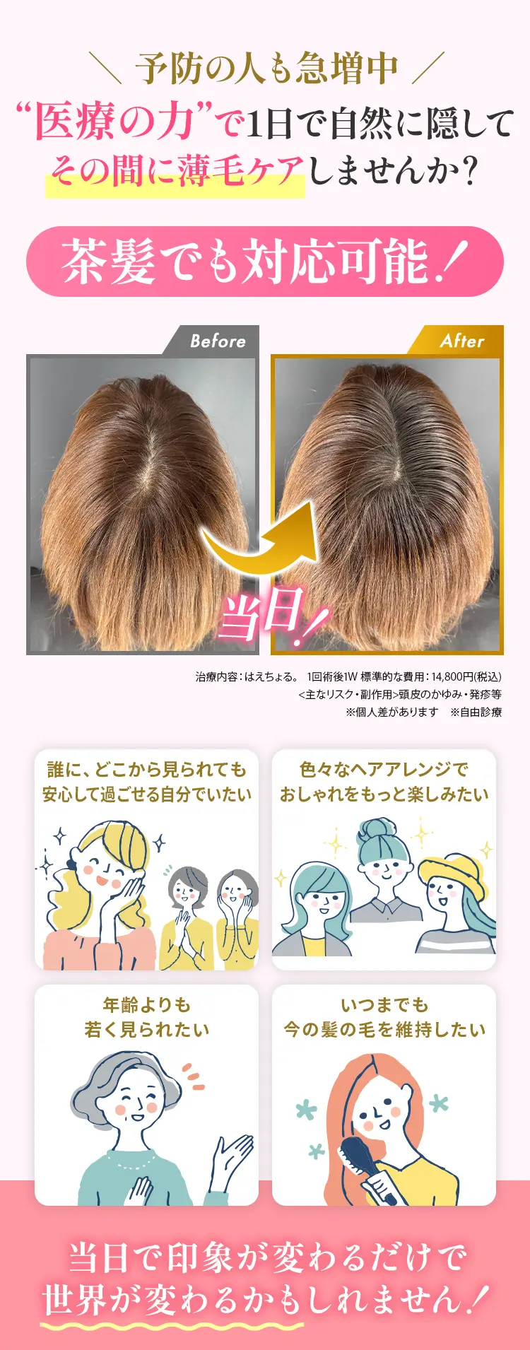 予防の人も急増中 医療の力で1日で自然に隠してその間に薄毛ケアしませんか？